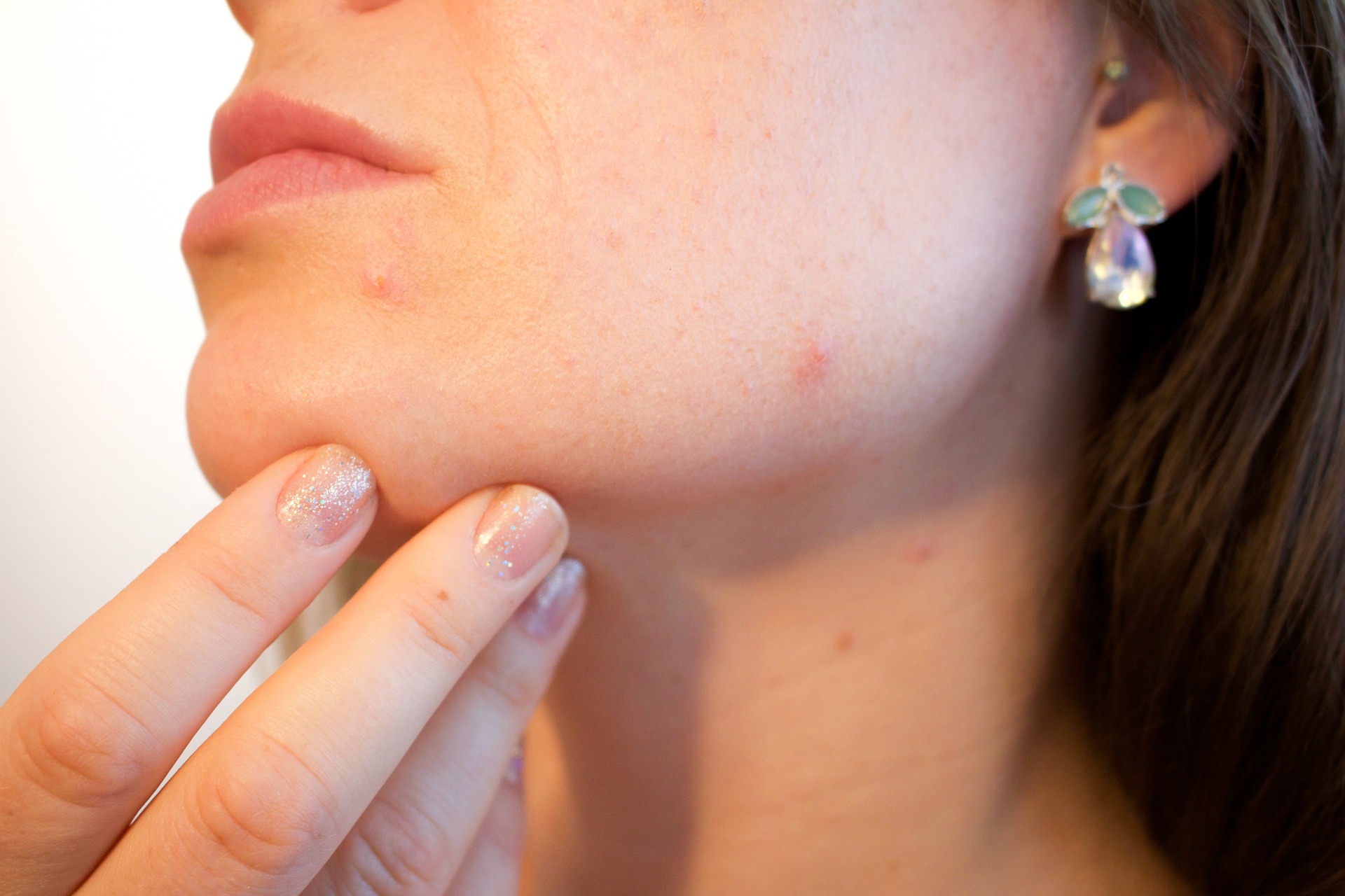 acne home remedies