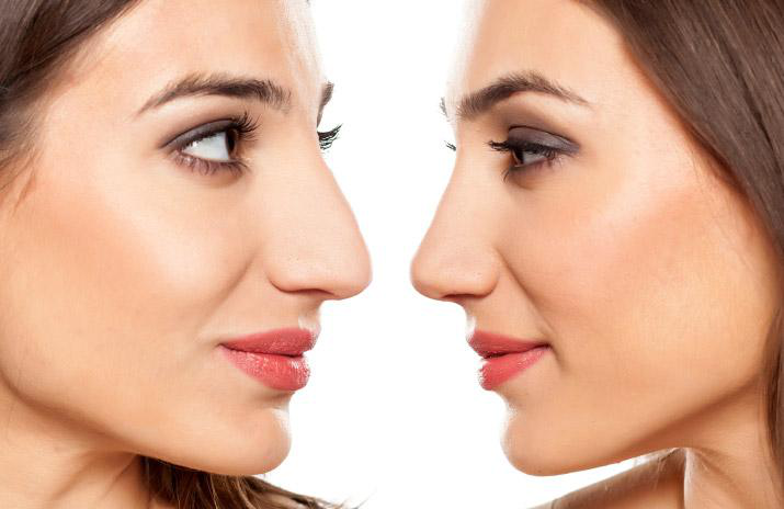 Nose Reshaping Surgery