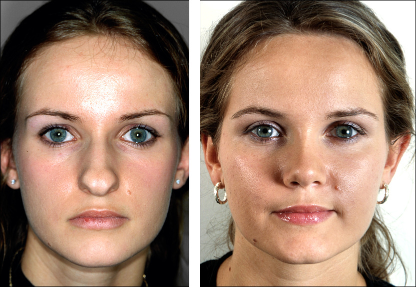 Rhinoplasty
